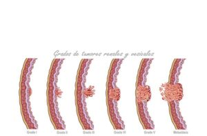 bladder cancer stadiums