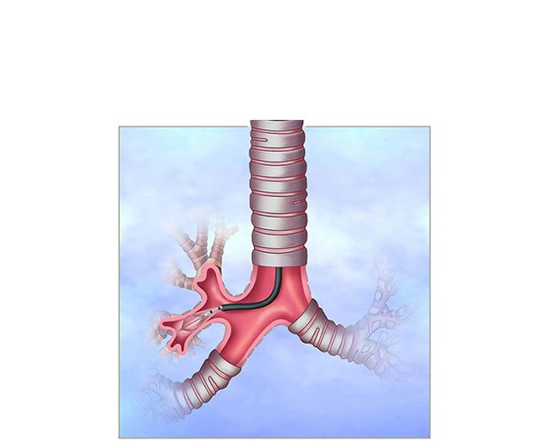 bronchoscopy examination bronchoscopy examination