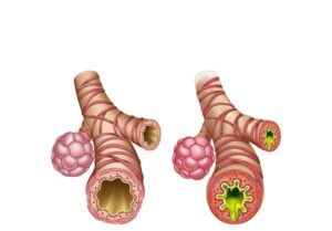 bronquio sano y bronquitis