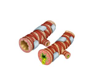 bronquiolo sano y bronquitis