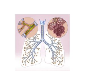 bronquitis emphysema
