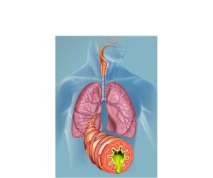 bronquitis cronica