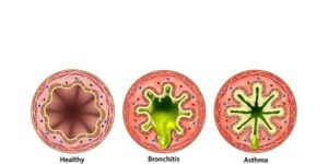 bronquitis y asma