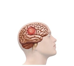 cabeza y cerebro con tumor