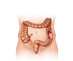 cancer de colon