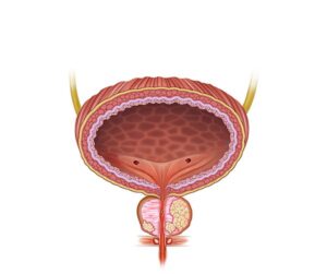 cancer de la prostata