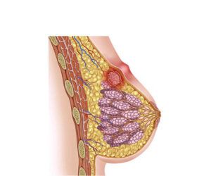 el cáncer de mamas