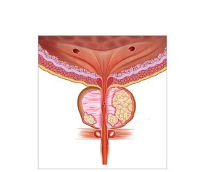 cancer de prostata
