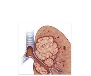 cáncer pulmonar