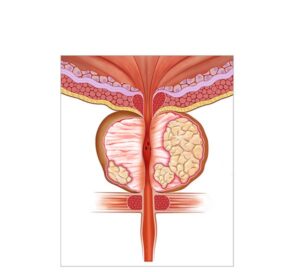 cancer prostata