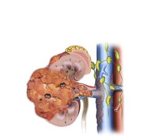 cáncer renal fase 4
