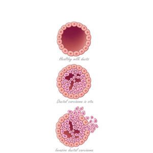 carcinoma in situ e invasivo