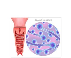 candidiasis