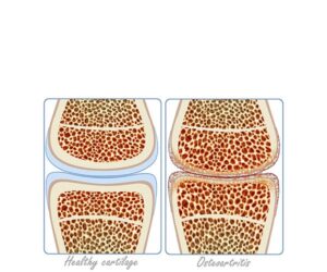 cartilage and osteoarthritis