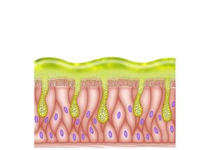 celulas epiteliales mucuosas alteradas