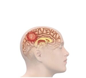 cerebro con tumor