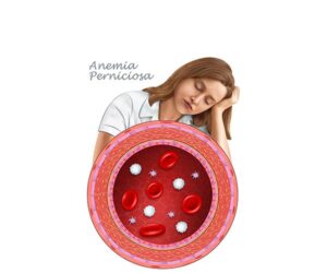 chica con anemia perniciosa