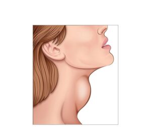 chica con teroiditis