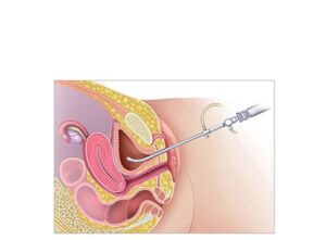 cistoscopia femenina