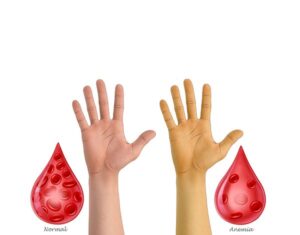 color de piel en anemia