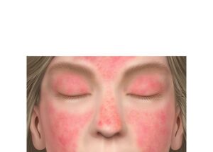 dermatomiositis