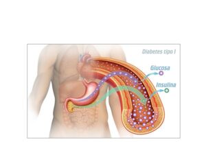 diabetes millitus tipo 1