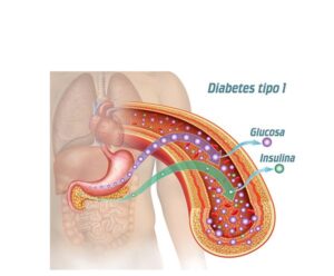 diabetes tipo 1