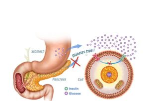 diabetes type 1