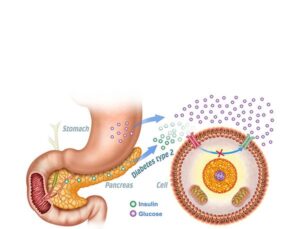 diabetes type 2