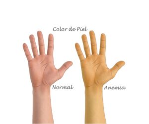 el color de piel en anemia