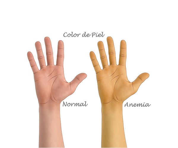 el color de piel en anemia el color de piel en anemia