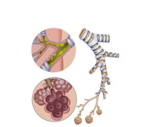 emphysema y bronquitis