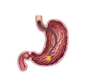 endoscopia del estomago