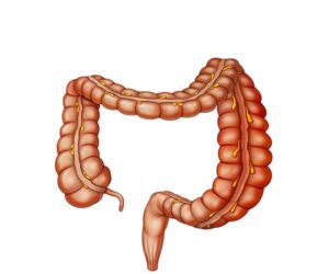 enfermedad hirschsprung
