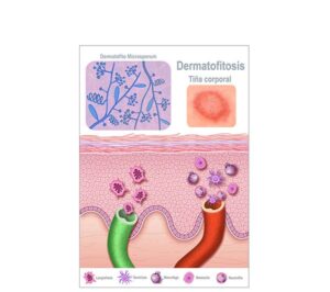 enfermedad de dermatofitosis