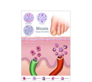 enfermedad de piel micosis