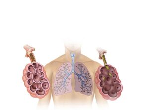 enfisema