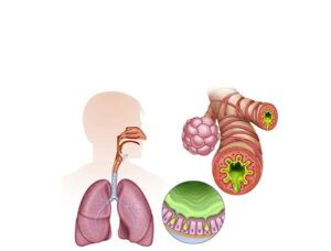 esquema de bronchitis