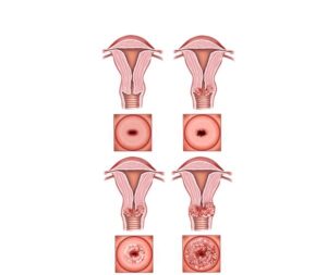 estadios tumor cervix