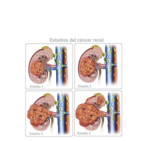 estadios cancer renal