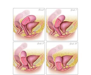 etapas del prolapso uterino