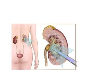 extracción cálculo renal