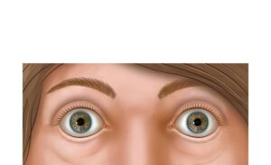 eyes with hyperthyroidism