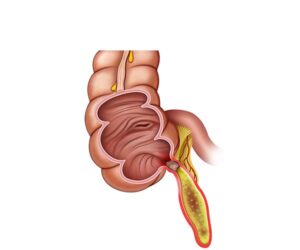 fluidos en apendicitis