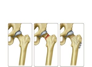 fractura cabeza cuello femoral