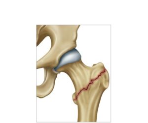fractura de femur intertrocantéreas