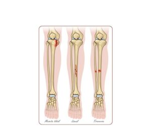 fractura hueso tibia