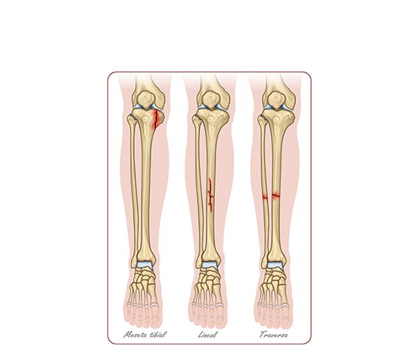 fractura hueso tibia fractura hueso tibia