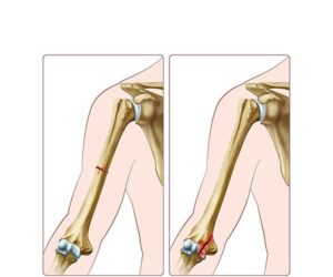 fractura traversa