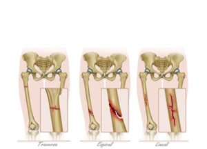 fracturas del femur